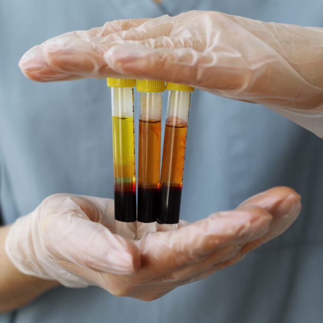 Vitamin D Testing Kits